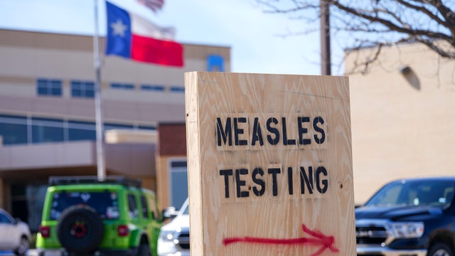 Measles-Explainer 